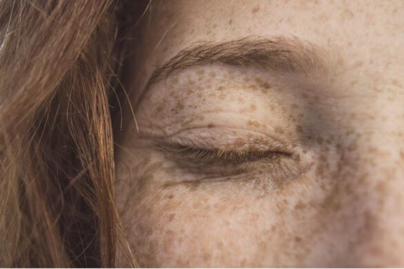 Only 5% of the world's population has freckles.