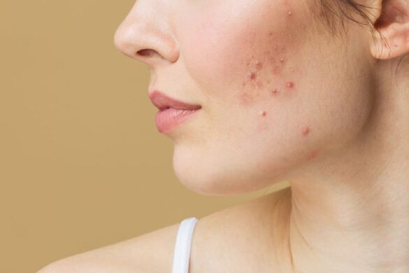 SPOTS ON THE SKIN.